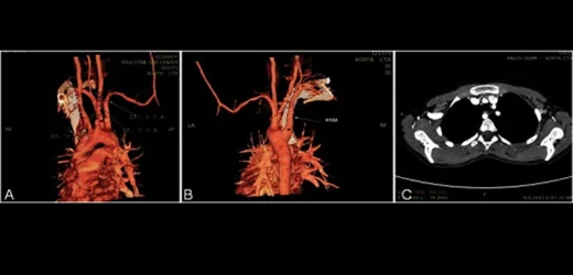 Hypertension With Right Subclavian Plaque Tied to CV Events