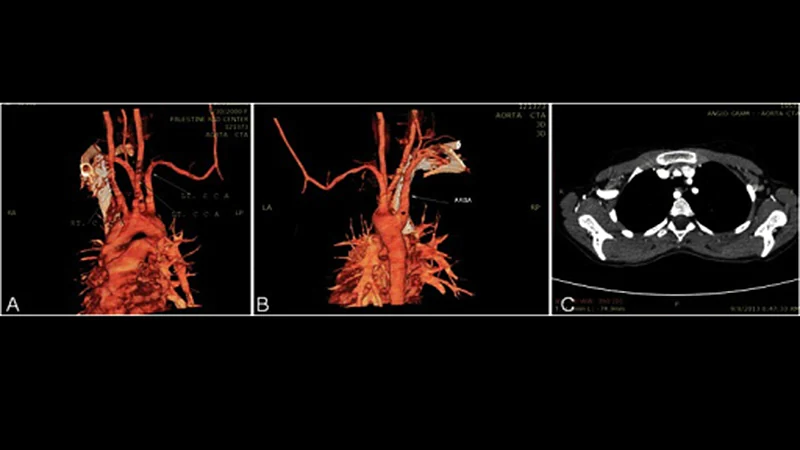 Hypertension With Right Subclavian Plaque Tied to CV Events