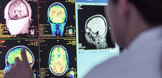Improved imaging finds MS lesions in ‘normal’ brain tissue