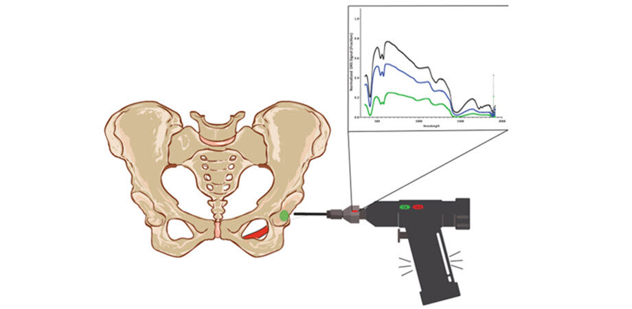 Optical sensing for orthopedic surgery