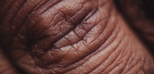 Skin-related side effects indicate better prognosis for patients taking certain cancer drugs