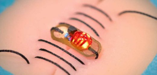 Smart sutures to monitor deep surgical wounds