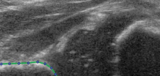 Ultrasound technique predicts hip dysplasia in infants