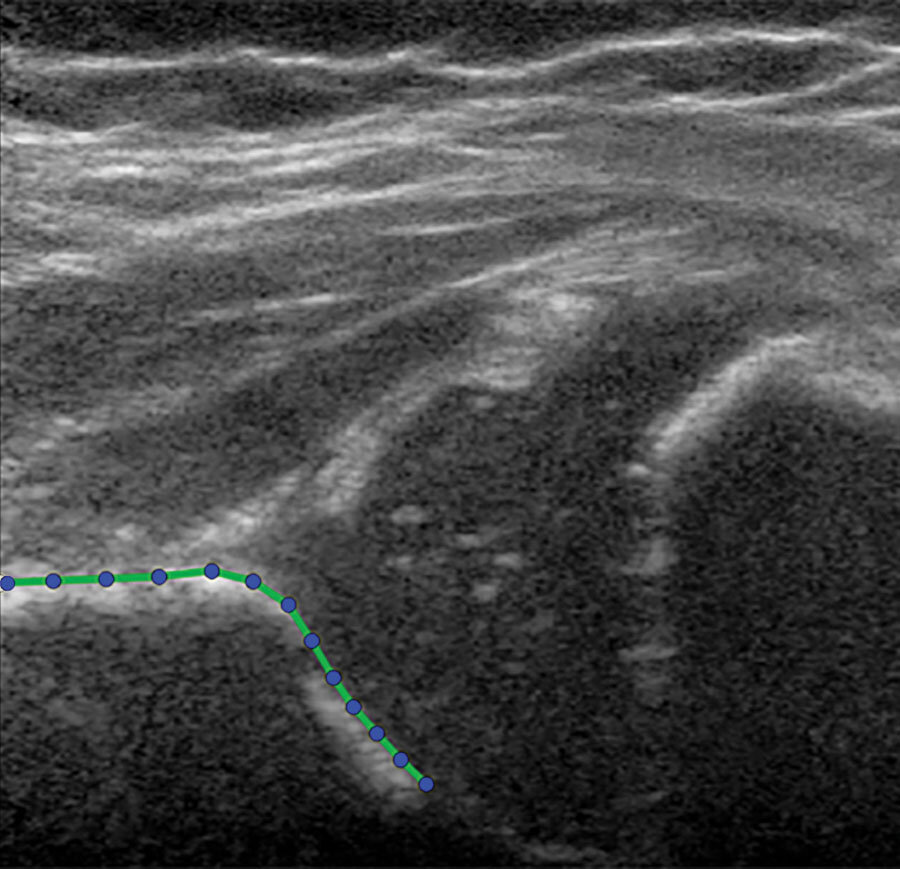 Ultrasound technique predicts hip dysplasia in infants