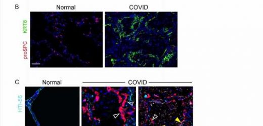 Disruption in lung cell repair may underlie ARDS in COVID-19 and other diseases