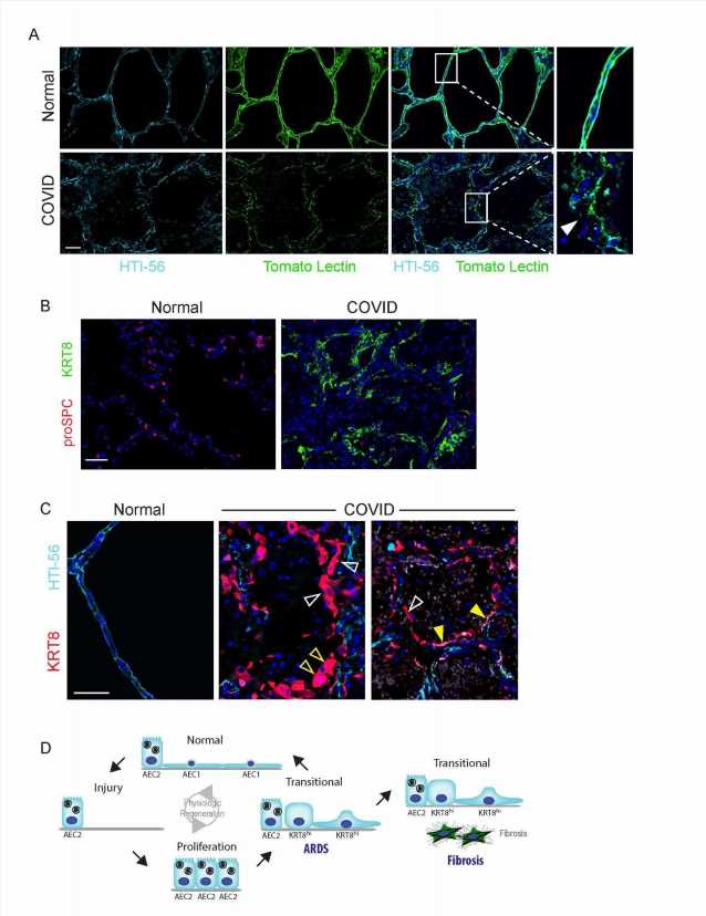 Disruption in lung cell repair may underlie ARDS in COVID-19 and other diseases