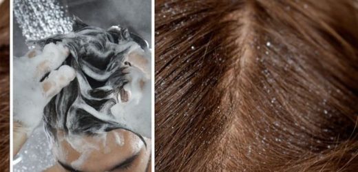 How to get rid of dandruff fast – Best home remedies to banish flaky scalps
