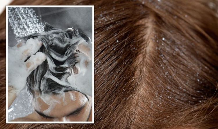 How to get rid of dandruff fast – Best home remedies to banish flaky scalps