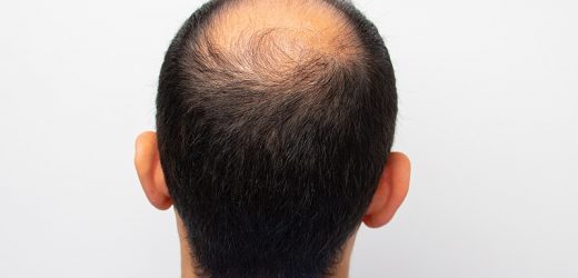 Male Alopecia Agents Ranked by Efficacy in Meta-Analysis