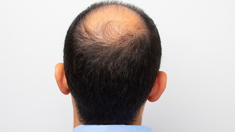 Male Alopecia Agents Ranked by Efficacy in Meta-Analysis