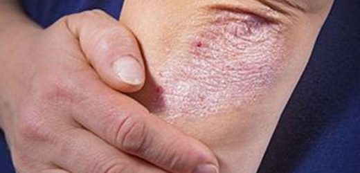 Model may predict PsA risk in patients with plaque psoriasis
