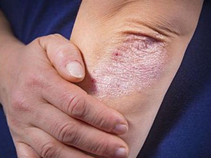 Model may predict PsA risk in patients with plaque psoriasis