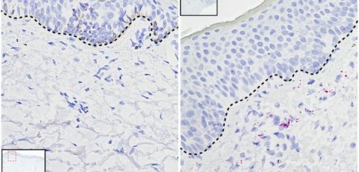 New insight into how atopic dermatitis develops