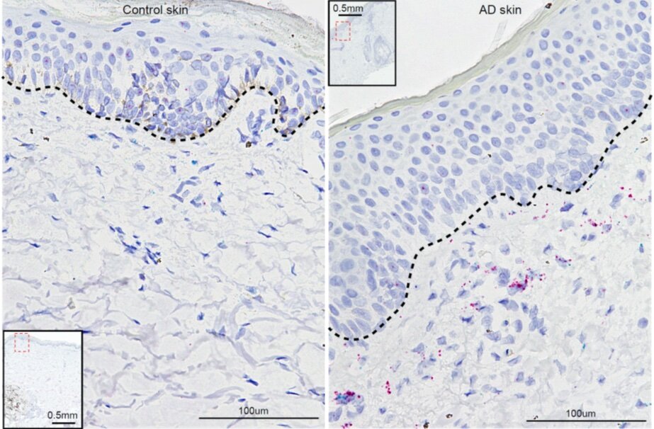 New insight into how atopic dermatitis develops