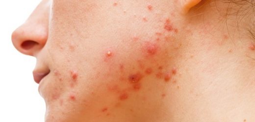 Study identifies 29 new genetic variants linked to acne