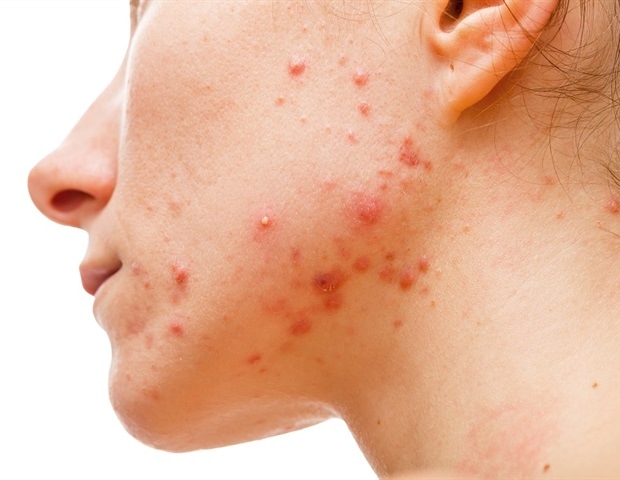 Study identifies 29 new genetic variants linked to acne