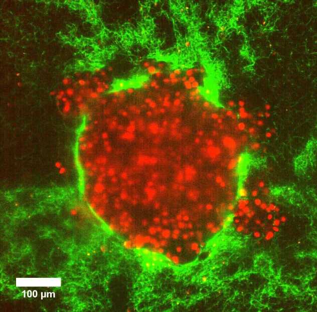 Burst of rapid cell motion in 3D tumor model could explain cancer metastasis