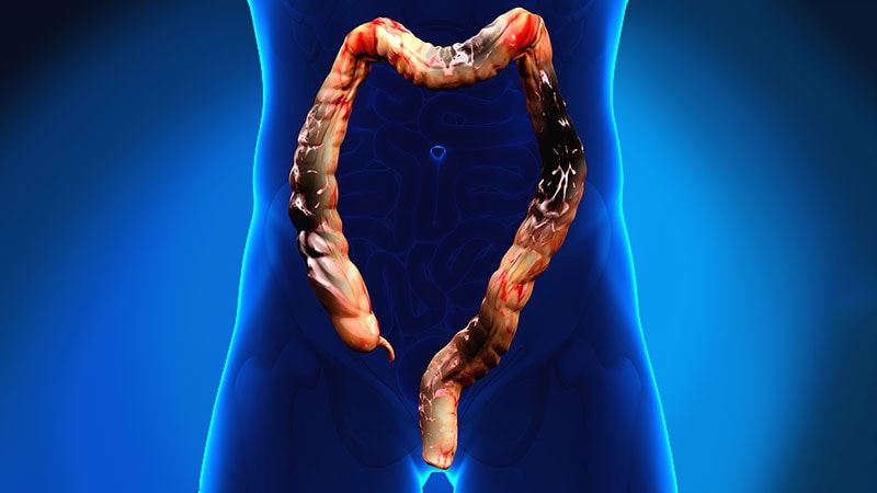 Colorectal Cancer Trials Enrolling: Could Your Patients Benefit?