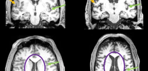 Even mild cases of COVID-19 can leave a mark on the brain, such as reductions in gray matter