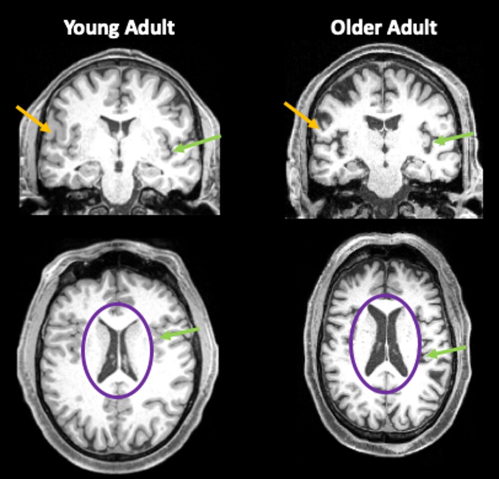 Even mild cases of COVID-19 can leave a mark on the brain, such as reductions in gray matter