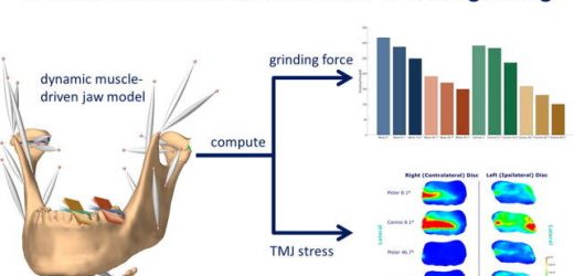 Nocturnal teeth grinding may damage temporomandibular joints