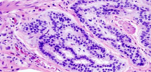Researcher advises doctors against overreliance on liquid biopsy used to screen for colorectal cancer recurrence