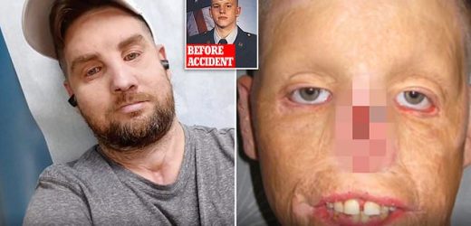 Soldier says face transplant is &apos;the best decision I ever made&apos;