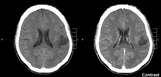 Spinal fluid sampling used to track treatment response in pediatric glioma
