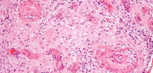 A blood test to differentiate severe COVID-19 from preeclampsia in pregnant women