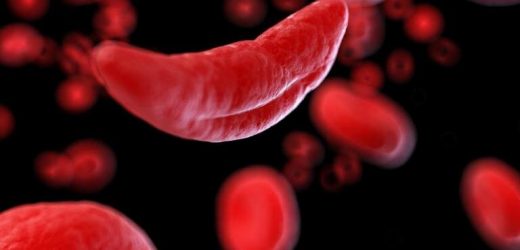 Corticosteroids raise the risk of hospitalization for pain crises among individuals living with sickle cell disease