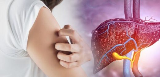 Fatty liver disease: Itching, bruising and yellow tinged skin indicates an unhealthy liver