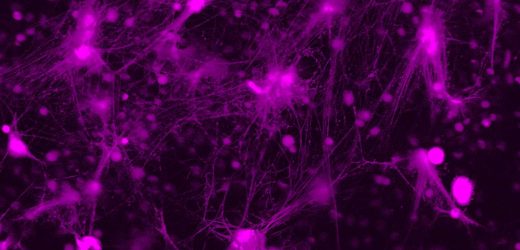 Keeping web-like NETs from clogging blood vessels could improve stroke outcomes