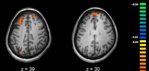 Landmark study reveals clearest genetic signals yet for schizophrenia risk