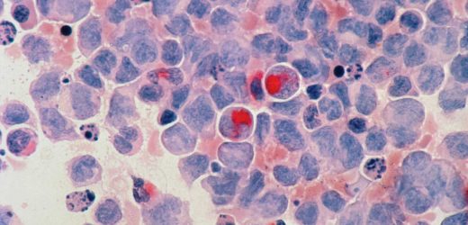Leukemia patients with certain gene regulation patterns may be less likely to respond to CAR T therapy