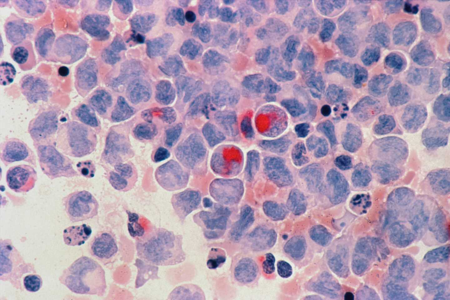 Leukemia patients with certain gene regulation patterns may be less likely to respond to CAR T therapy