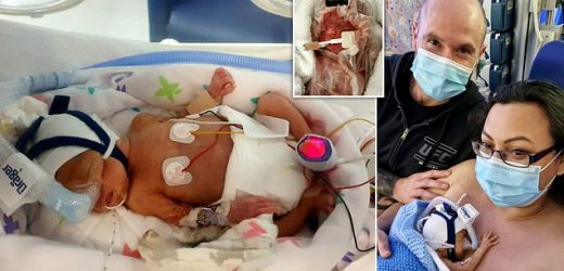 Mother reveals doctors saved premature baby by wrapping him in a BAG