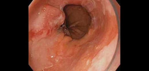 New Barrett’s Esophagus Guideline Reduces Reliance on Endoscopy