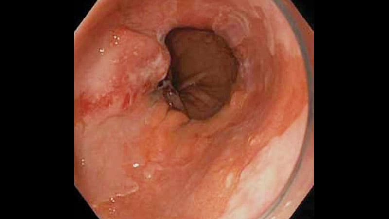 New Barrett’s Esophagus Guideline Reduces Reliance on Endoscopy