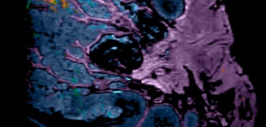 Researchers identify immunosuppression as a key factor leading to colorectal cancer development