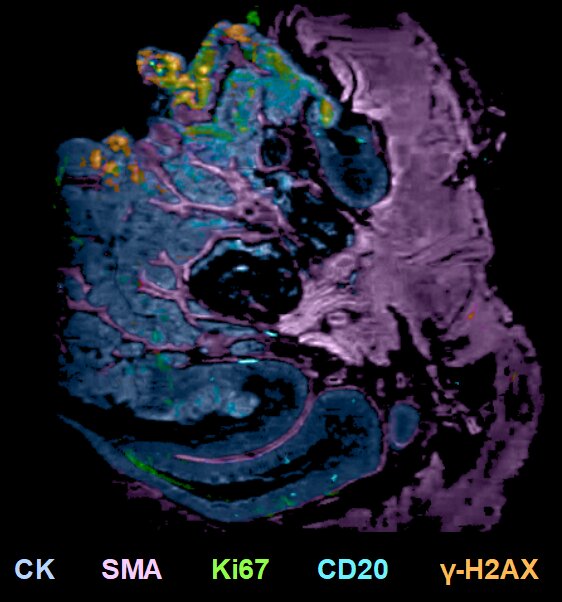 Researchers identify immunosuppression as a key factor leading to colorectal cancer development