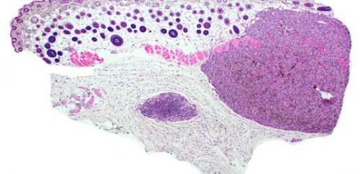 Researchers use CRISPR to build melanoma models from scratch using human cells