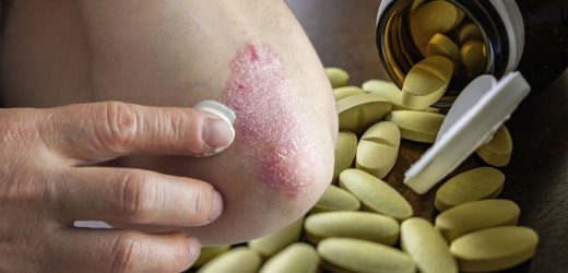 Statin side effects: Risk of drug-induced eczema may be ‘significant among users – study
