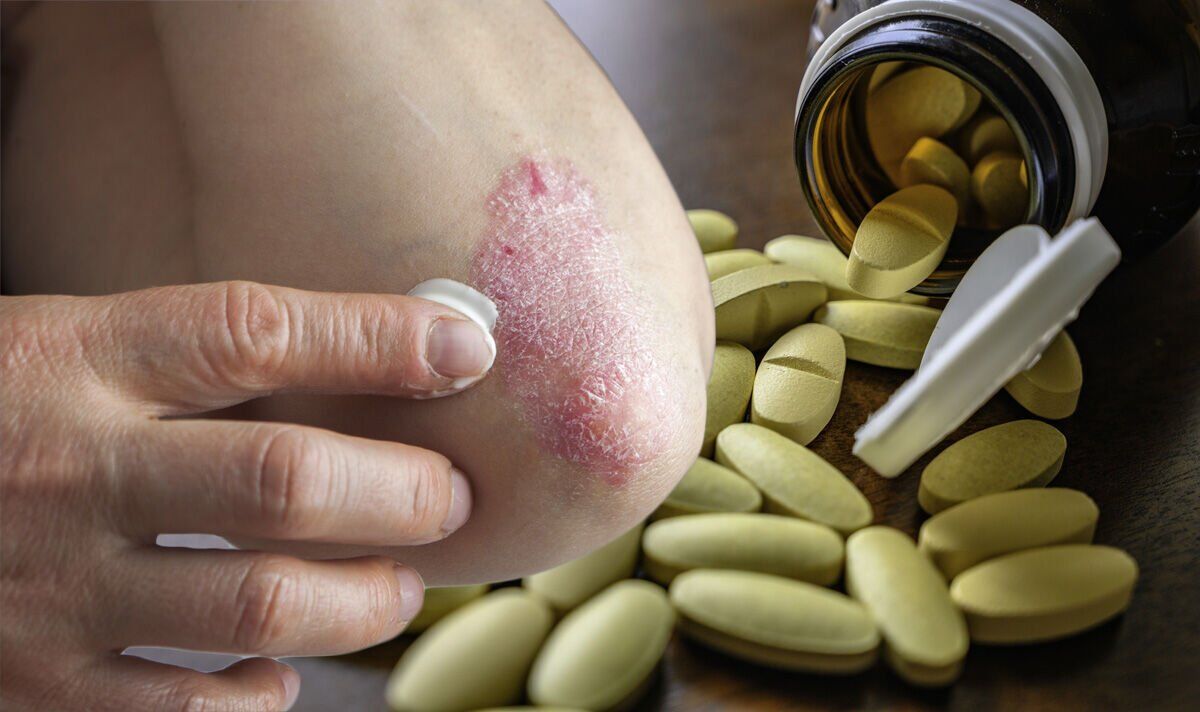 Statin side effects: Risk of drug-induced eczema may be ‘significant among users – study