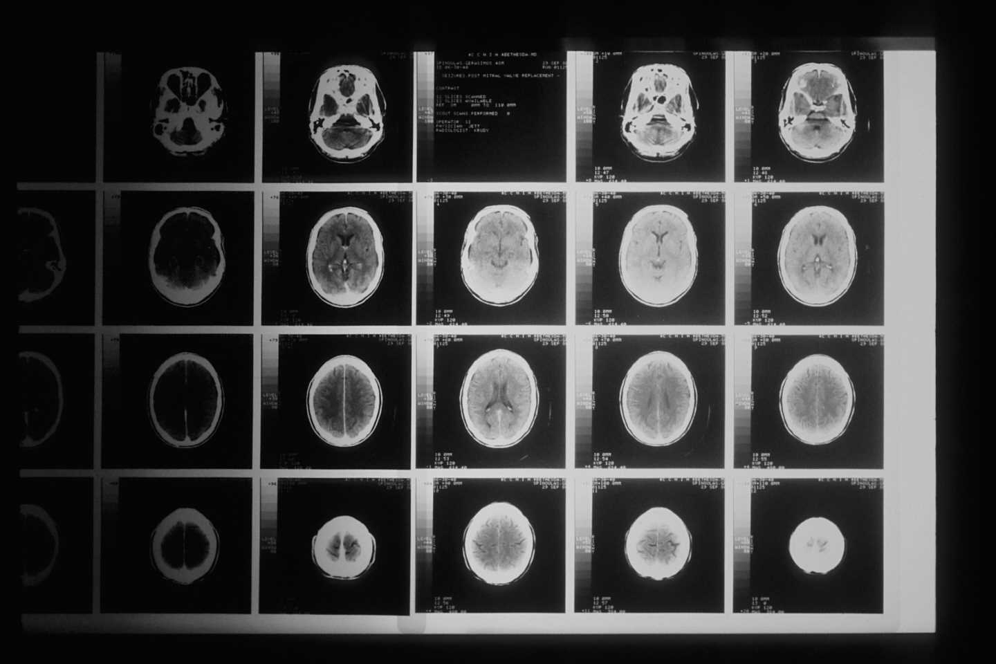 Using AI to diagnose mild cognitive impairment that progresses to Alzheimer’s