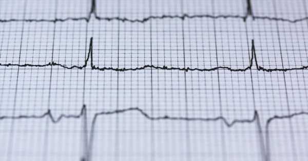 AI can help ID patients at higher risk of stroke, Mayo Clinic study finds