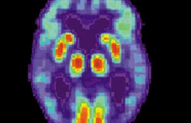 Dementia: Combination of ‘feelings’ and measurements suggest Alzheimer’s in the early stage