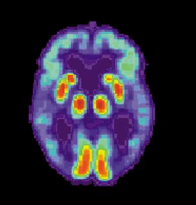 Dementia: Combination of ‘feelings’ and measurements suggest Alzheimer’s in the early stage