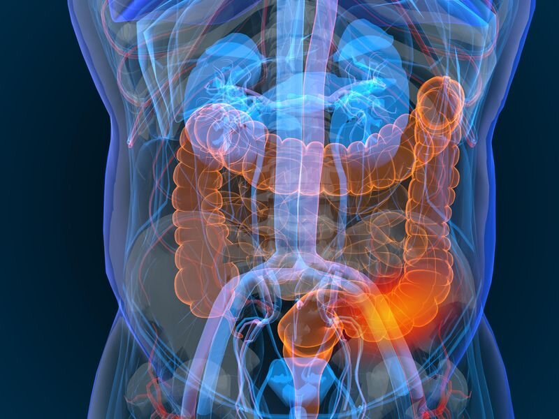 Heavy antibiotic use tied to development of Crohn’s, colitis