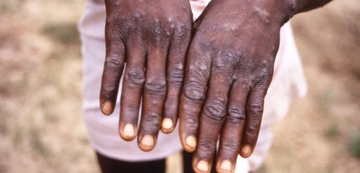 Monkeypox ‘unlikely’ to be next pandemic due to how it transmits, expert says