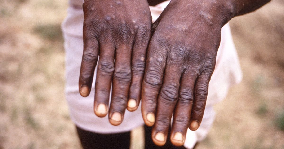 Monkeypox ‘unlikely’ to be next pandemic due to how it transmits, expert says